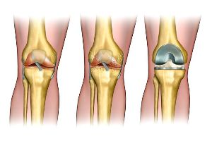 the degree of osteoarthritis