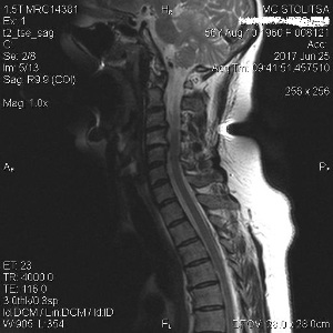 Osteochondrosis and spondylosis of the cervical spine
