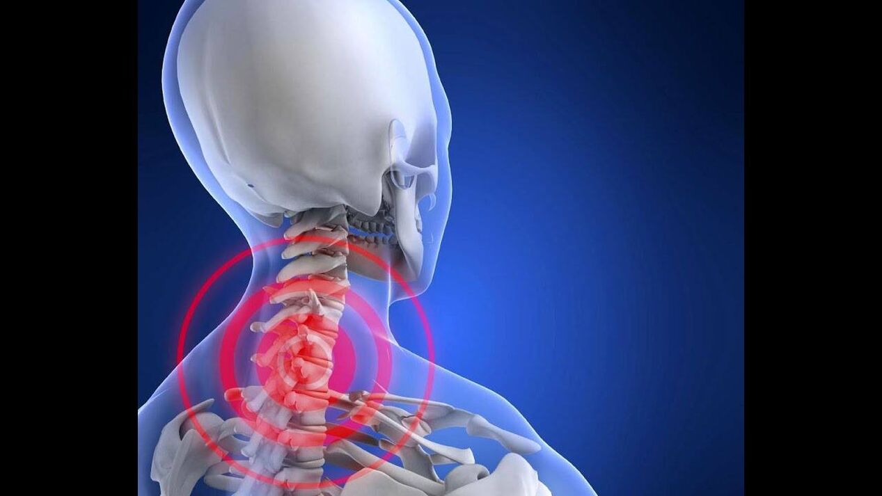 Cervical spine osteochondrosis
