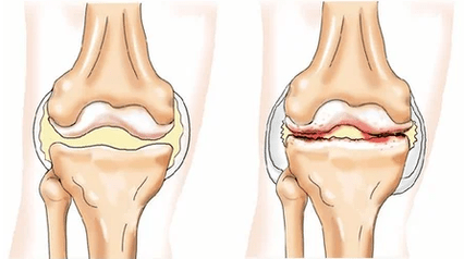 Chondomatosis