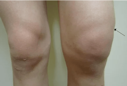 Knee joint hemarthrosis