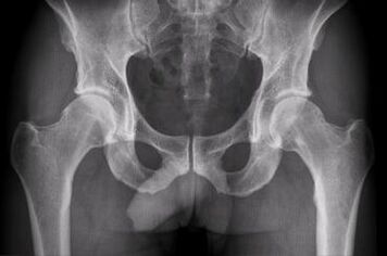 Diagnosis options for hip joint arthrosis