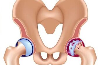 Stages of hip arthrosis development