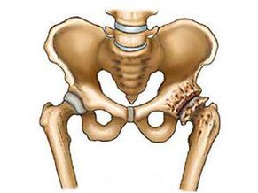 What is hip articulation arthrosis