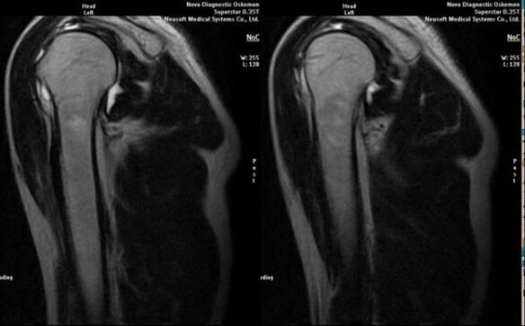 X-ray to diagnose shoulder osteoarthritis